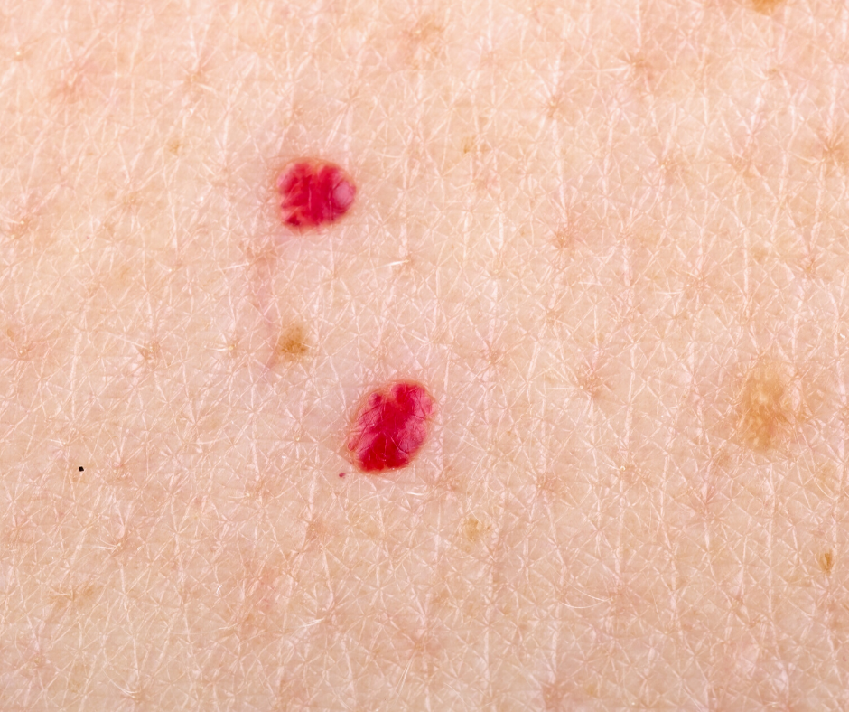 teresa-paquin-cherry-angiomas-what-are-they-how-do-i-get-rid-of-them